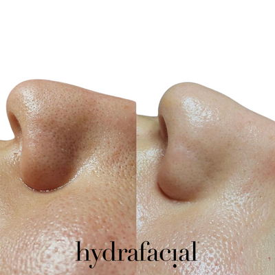 HYDRAFACIAL MD