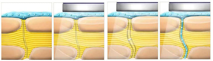 Ultraschallbehandlung