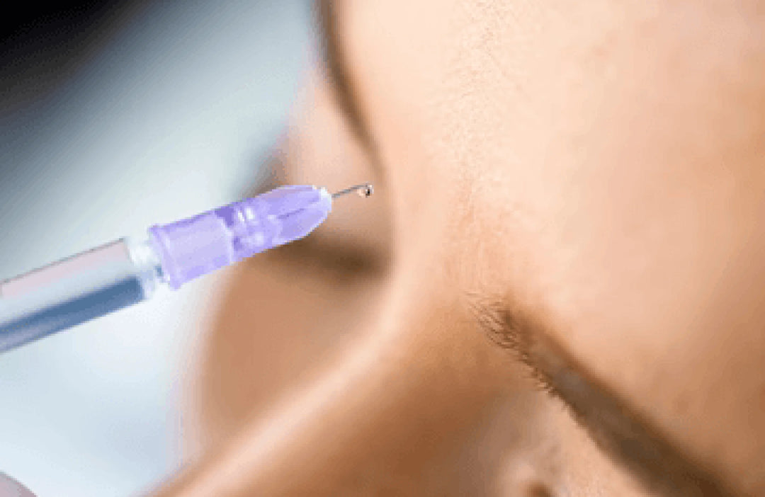 Faltenunterspritzung zur sanften Glättung mimischer Linien im PDB Aesthetic Room Wiesbaden
