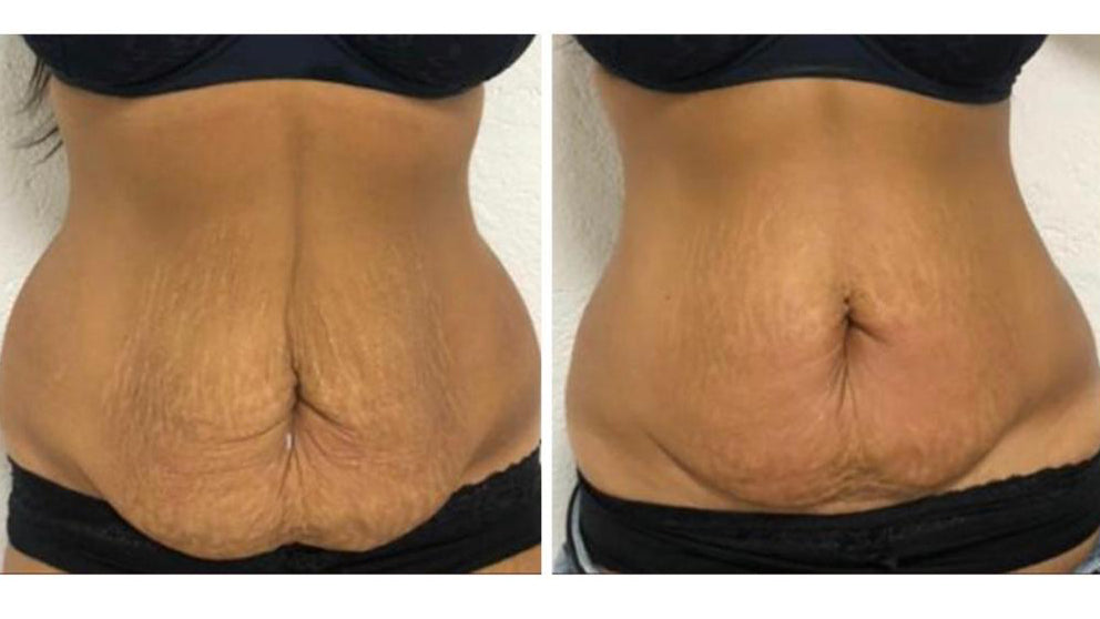 REFIT Behandlung zur Hautstraffung und Körperformung im PDB Aesthetic Room Wiesbaden
