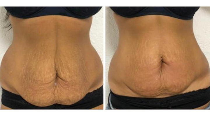 REFIT Behandlung zur Hautstraffung und Körperformung im PDB Aesthetic Room Wiesbaden
